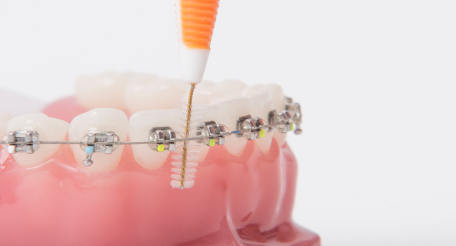 seitliche Zeichnung eines menschlichen Kiefers mit Zahnspangen-Brackets auf den Zähnen, ein Pinsel trägt Schutzlack auf die Zahnoberflächen rund um die Brackets auf